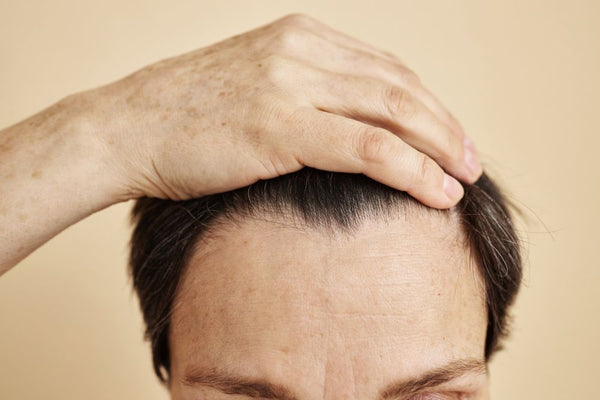 How to Grow Hair in the Forehead Area (Front Hairline)